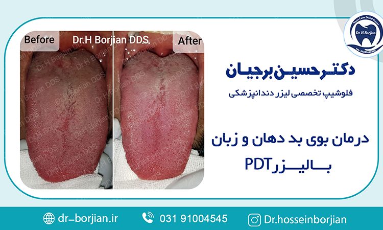 درمان بوی بد دهان و زبان با لیزر PDT|بهترین دندانپزشک اصفهان