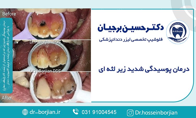 درمان پوسیدگی شدید زیر لثه ای و استخوان از سمت کام |بهترین دندانپزشک اصفهان