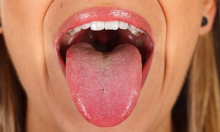 Diagnosing the symptoms of tongue cancer | The best implant in Isfahan