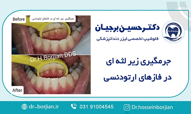 جرمگیری زیر لثه ای در فازهای ارتودنسی | بهترین دندانپزشک اصفهان