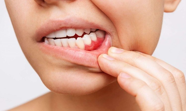 روش های خانگی رفع درد لثه | Le meilleur dentiste d'Ispahan