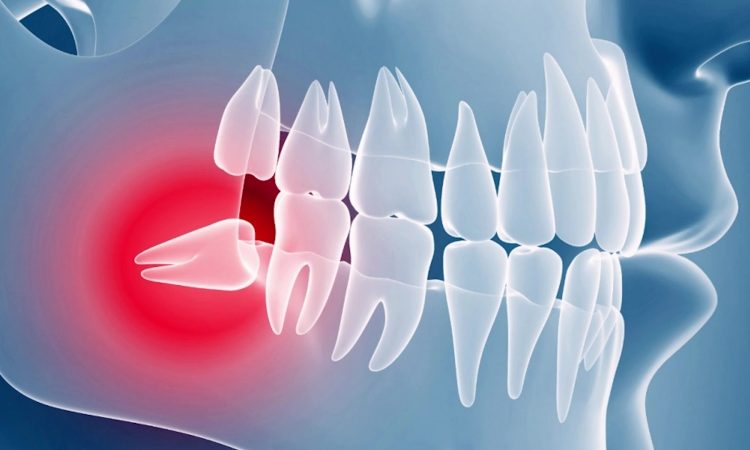 Wisdom tooth infection treatment methods | The best implant in Isfahan