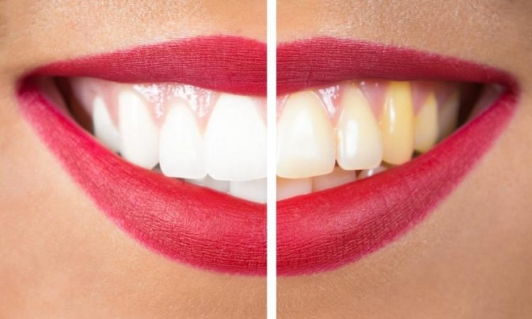 Methods of prevention and treatment of yellow teeth | The best cosmetic dentist in Isfahan