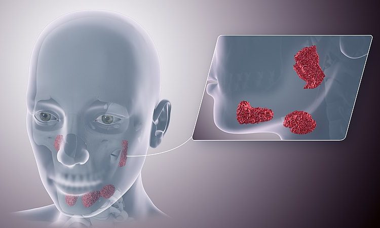 Symptoms of salivary gland disorder | The best gum surgeon in Isfahan