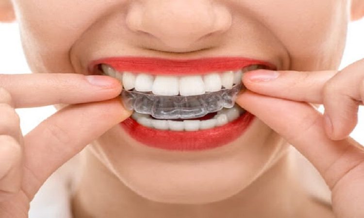 Quels sont les avantages et les inconvénients de l'orthodontie au gel ? | Le meilleur dentiste d'Ispahan - le meilleur chirurgien des gencives d'Ispahan - le meilleur dentiste cosmétique d'Ispahan