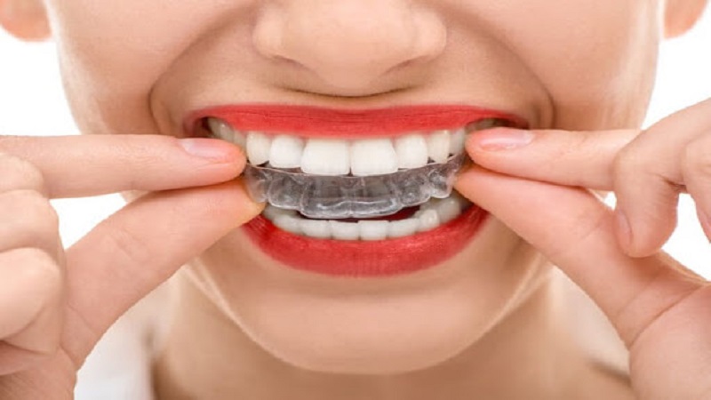 What are the advantages and disadvantages of gel orthodontics? | The best dentist in Isfahan - the best gum surgeon in Isfahan - the best cosmetic dentist in Isfahan