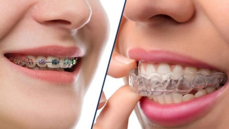 Quels sont les avantages et les inconvénients de l'orthodontie au gel ? | Le meilleur dentiste d'Ispahan - le meilleur chirurgien des gencives d'Ispahan - le meilleur dentiste cosmétique d'Ispahan