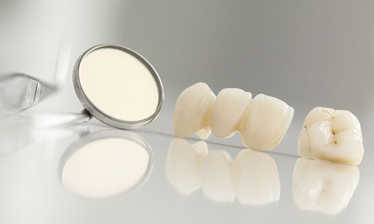 میزان دوام بریج‌های دندانی | The best gum surgeon in Isfahan