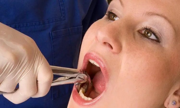 نکات مراقبتی بعد از جراحی دندان عقل | The best gum surgeon in Isfahan