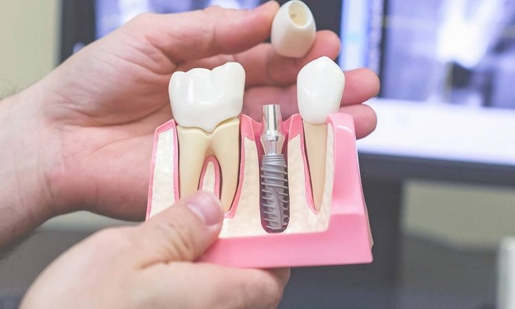 Care tips after dental implant healing | The best dentist in Isfahan