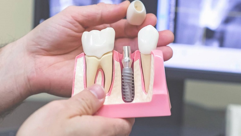 نکات مراقبتی بعد از هیلینگ ایمپلنت دندان | بهترین دندانپزشک اصفهان