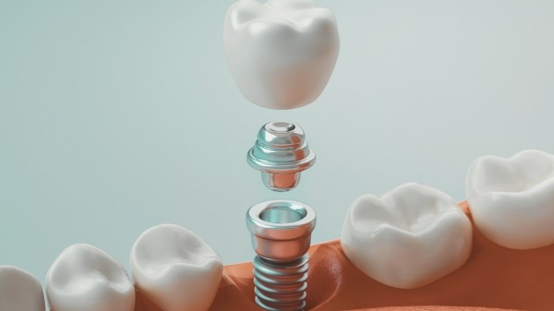 هیلینگ در کاشت ایمپلنت دندان | بهترین دندانپزشک اصفهان