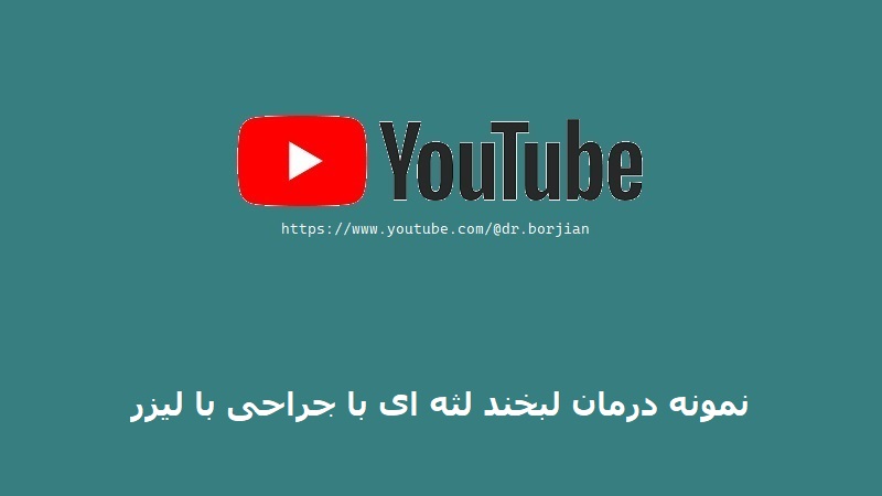 نمونه درمان لبخند لثه ای با جراحی با لیزر