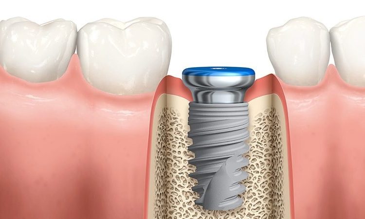 Le meilleur âge pour les implants dentaires | Le meilleur chirurgien des gencives à Ispahan