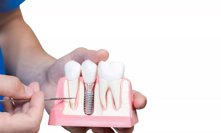 حقیقت سرطان زا بودن ایمپلنت دندان | بهترین جراح لثه اصفهان