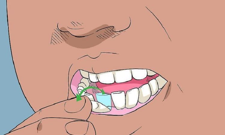 راه های تقویت دندان های لق | Le meilleur implant à Ispahan