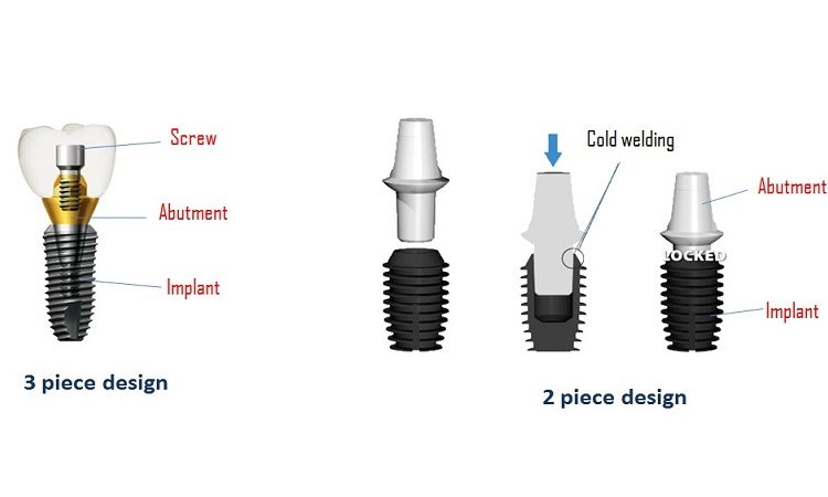 روش های مختلف کاشت ایمپلنت دندان | Le meilleur dentiste cosmétique à Ispahan