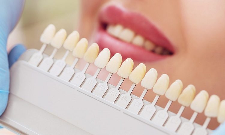 طرق رعاية تصفيح الأسنان | افضل دكتور اسنان تجميلي في اصفهان