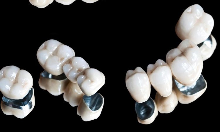 علل خارج کردن روکش دندان | بهترین دندانپزشک زیبایی اصفهان