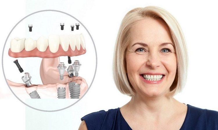 Durée de vie utile des implants dentaires | Le meilleur implant à Ispahan