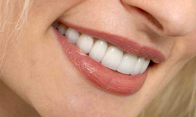عوارض و معایب لمینت دندان | Le meilleur implant à Ispahan