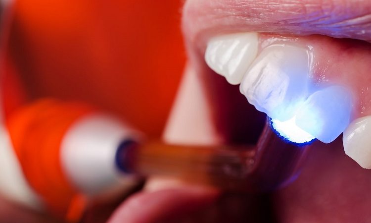 Complications of dental composite | The best cosmetic dentist in Isfahan