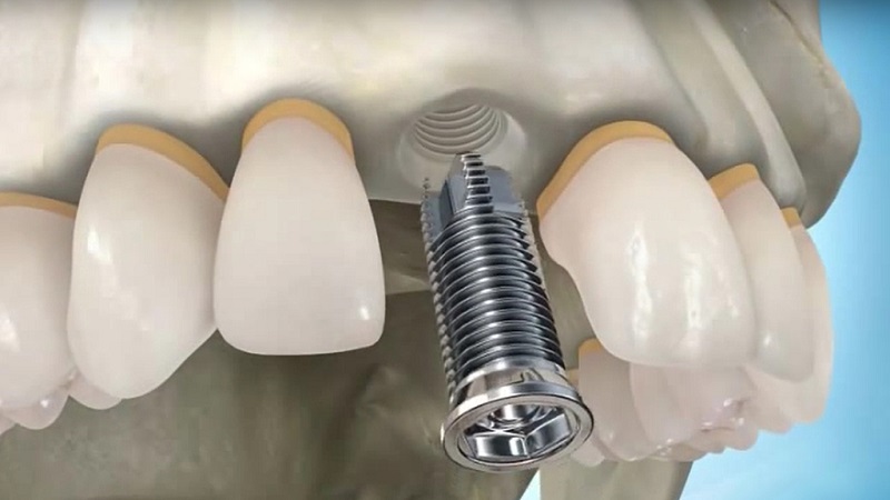 عوامل اثرگذار بر قیمت هیلینگ ایمپلنت | بهترین دندانپزشک اصفهان