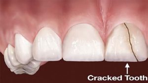 Care and treatment of full or broken teeth | The best cosmetic dentist in Isfahan