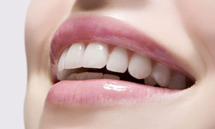 Advantages and disadvantages of dental composite veneers | The best gum surgeon in Isfahan