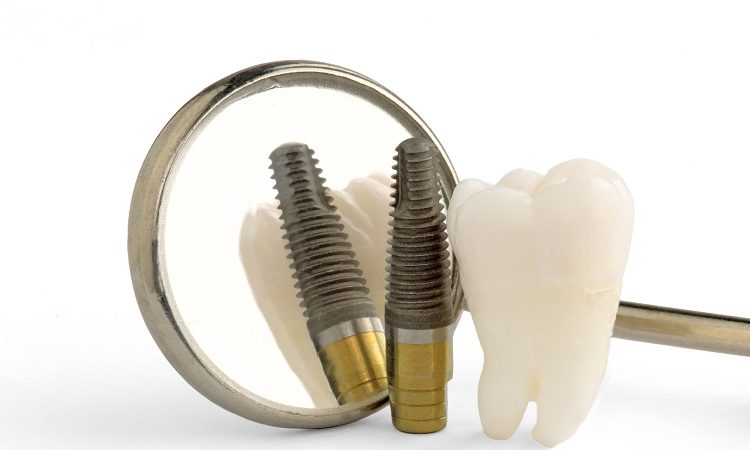 Advantages and disadvantages of implanting titanium dental implants | The best dentist in Isfahan