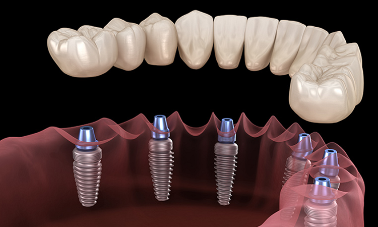 مزایای دندان مصنوعی بر پایه ایمپلنت | Le meilleur dentiste cosmétique à Ispahan