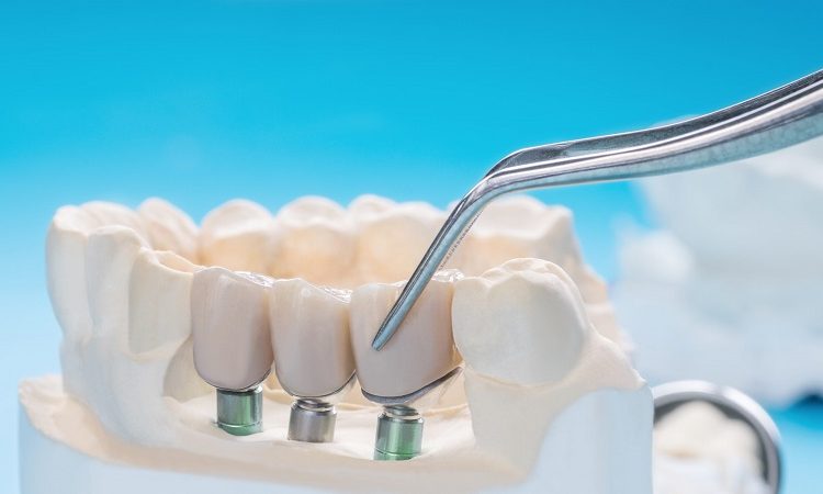 Introduction de dents artificielles basées sur des implants | Le meilleur dentiste d'Ispahan