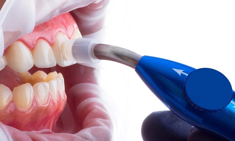 نکات مراقبتی برای ونیر کامپوزیت دندان | افضل دكتور اسنان تجميلي في اصفهان