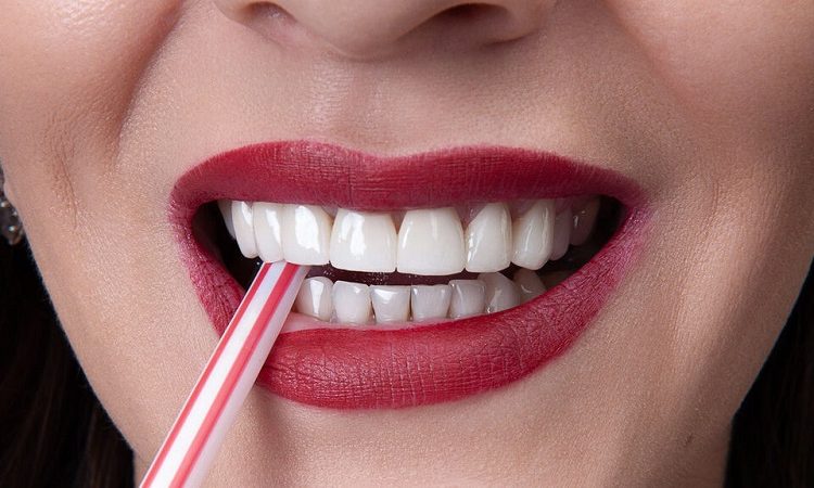 قشرة الأسنان المركبة IPS | افضل دكتور اسنان تجميلي في اصفهان
