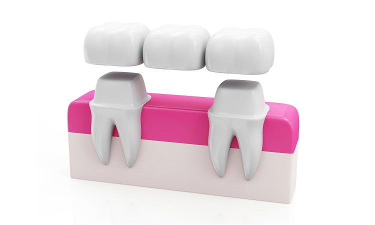 کاربرد انواع بریج های دندانی | بهترین جراح لثه اصفهان