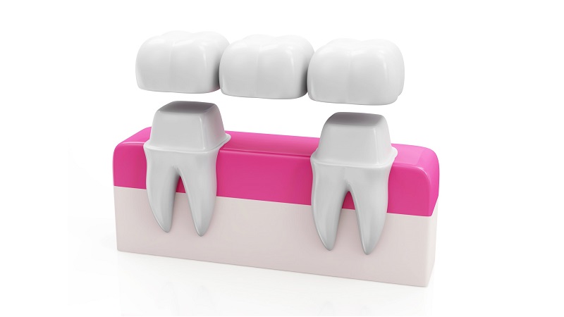 کاربرد انواع بریج های دندانی | بهترین جراح لثه اصفهان