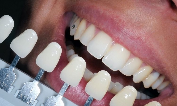 معرفی انواع مختلف لمینت دندان | بهترین ایمپلنت اصفهان