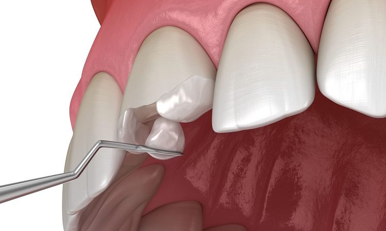 Réparation du gonflement des lèvres et de la fracture du composite dentaire | Le meilleur dentiste cosmétique à Ispahan