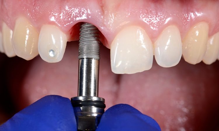 تعداد واحد ایمپلنت مورد نیاز برای کاشت | Le meilleur dentiste d'Ispahan