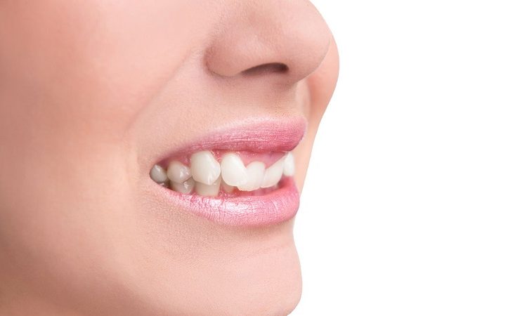 Traitement des dents tordues avec du composite | Le meilleur dentiste cosmétique à Ispahan