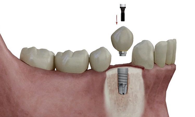 دلایل افتادن روکش ایمپلنت دندان | The best implant in Isfahan