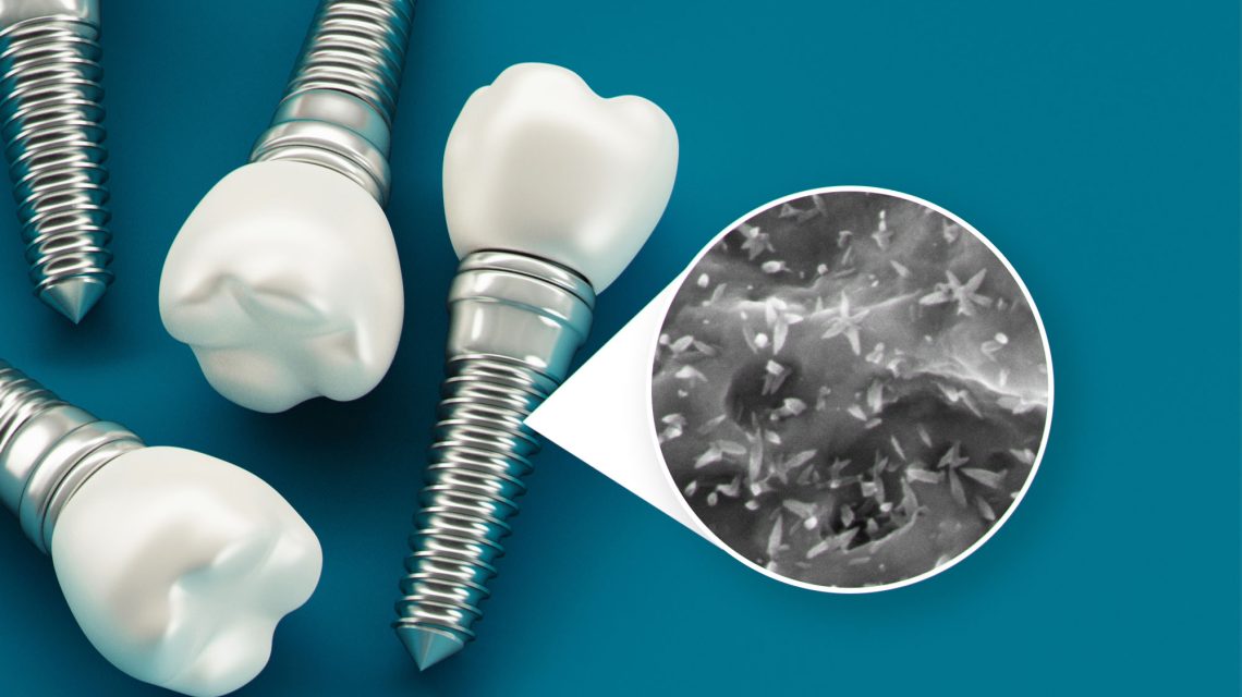 علل رایج شکست خوردن ایمپلنت دندان | بهترین دندانپزشک زیبایی اصفهان