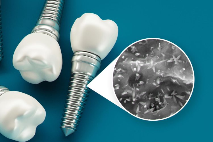 علل رایج شکست خوردن ایمپلنت دندان | بهترین دندانپزشک زیبایی اصفهان