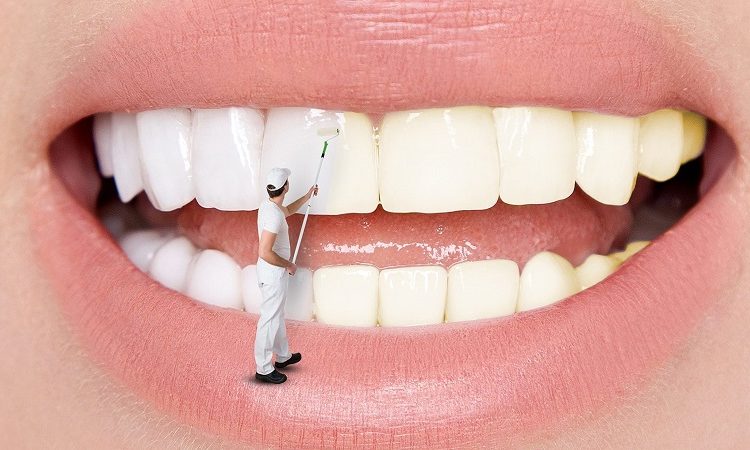 عوارض و معایب بلیچینگ دندان | بهترین جراح لثه اصفهان