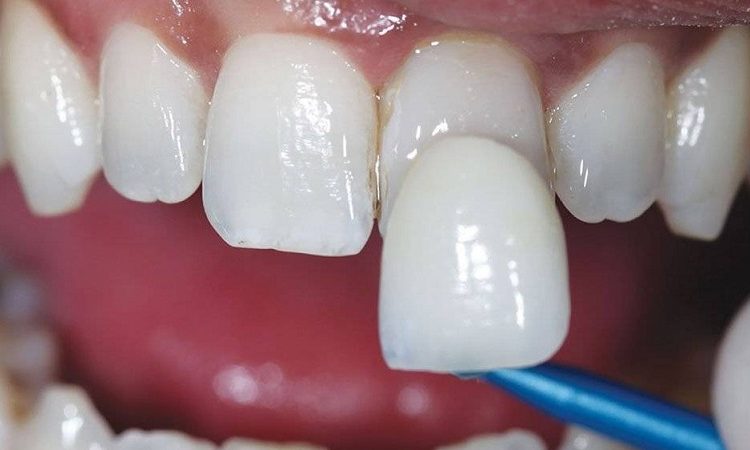 مراحل کامپوزیت دندان خرگوشی | بهترین دندانپزشک اصفهان