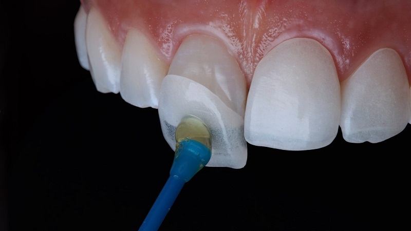 مزایای جایگزین کردن ونیرکامپوزیت شکسته با لمینت سرامیکی | بهترین دندانپزشک اصفهان