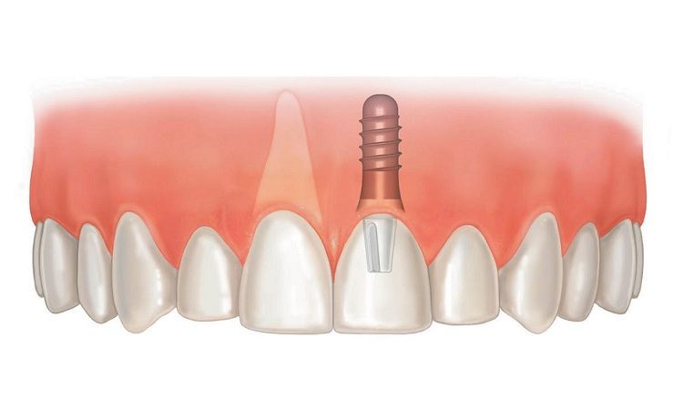 مزیت های کاشت ایمپلنت دندان جلو | بهترین دندانپزشک اصفهان