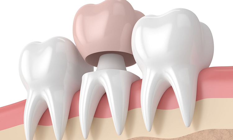 مقایسه کامپوزیت دندان با روکش دندان | بهترین ایمپلنت اصفهان