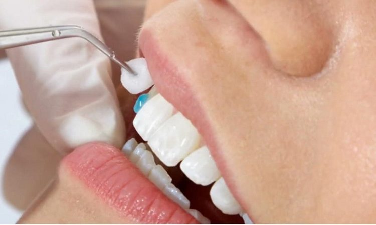 Application cases of dental veneer adhesives | The best cosmetic dentist in Isfahan