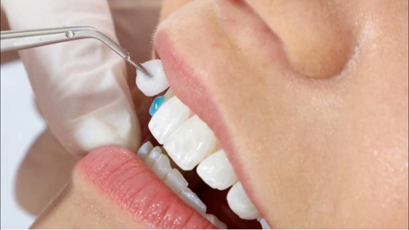 موارد کاربرد انواع چسب روکش دندان | بهترین دندانپزشک زیبایی اصفهان